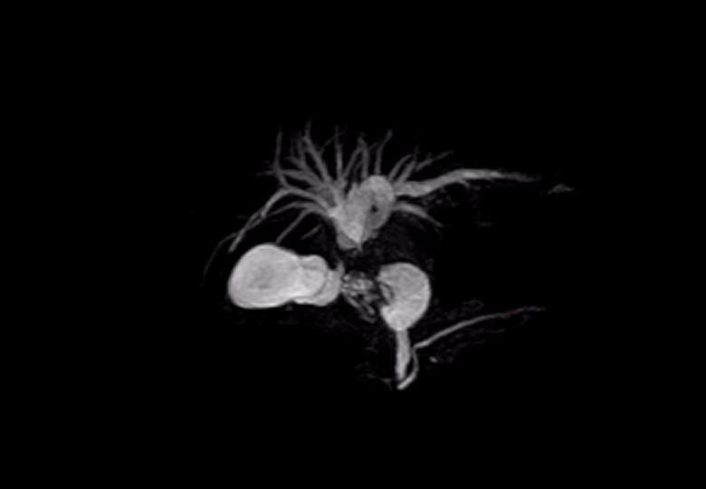  MRCP_ssfse3d_cor_trig_MIP 