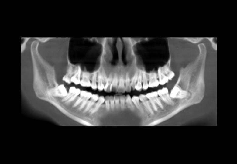 5mm panorama