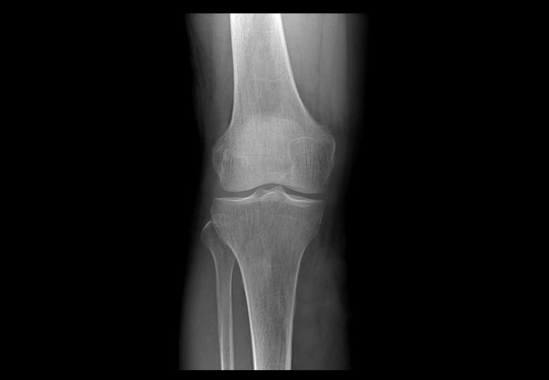 Knee joint ortho position