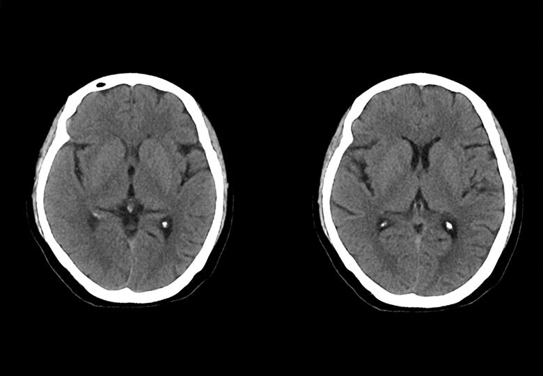 Routine scan(5mm)