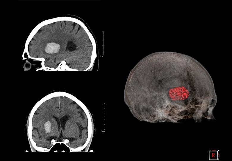 Cerebral Hemorrhage Analysis