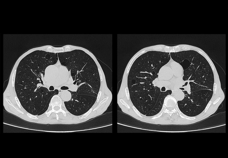 Ultrathin chest imaging (0.3125mm)