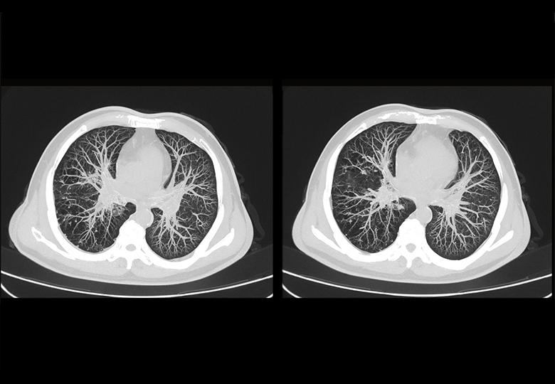 Chest three-dimensional post-processing (MIP)