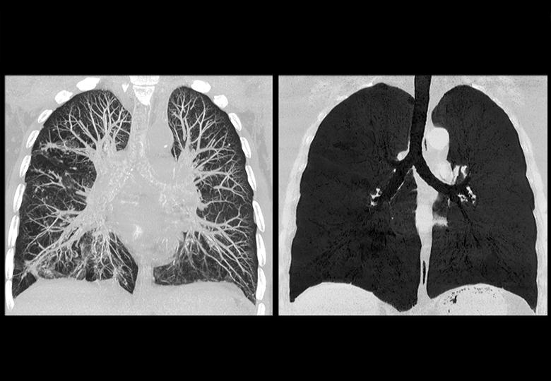 Three-dimensional post-processing of the chest (MIP, MinIP)