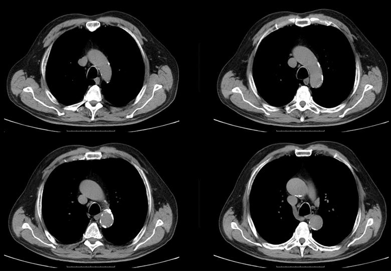 Routine chest_Mediastinum window