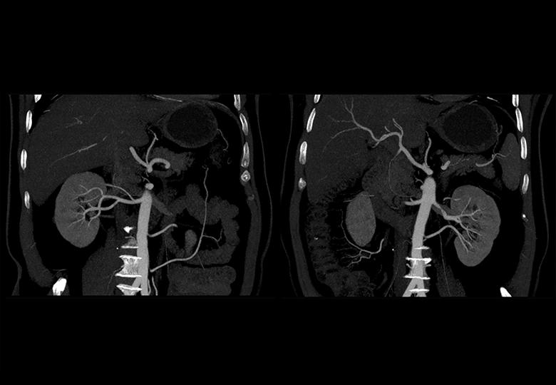 Abdominal CTA