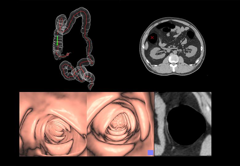 Colon analysis