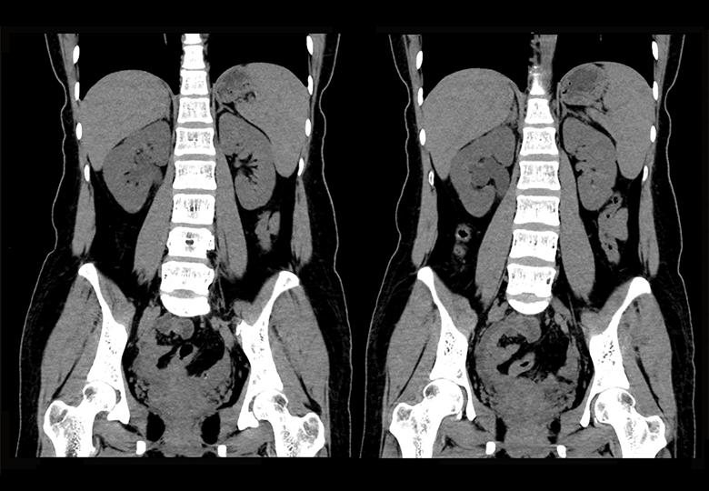 Routine_1mm_Kidney