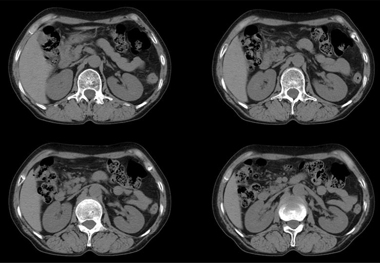 Routine_5mm_Kidney