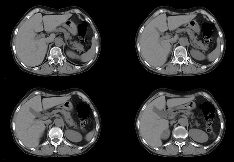 Routine_5mm_Pancreas