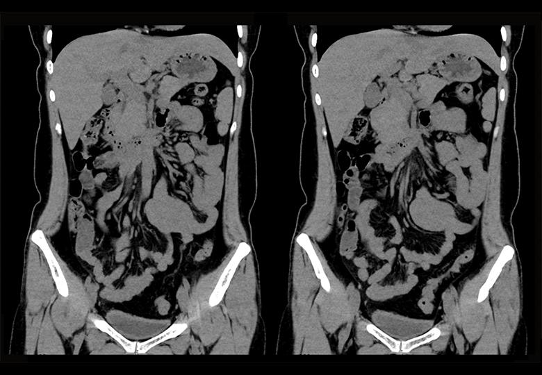 Routine_MPR_Liver