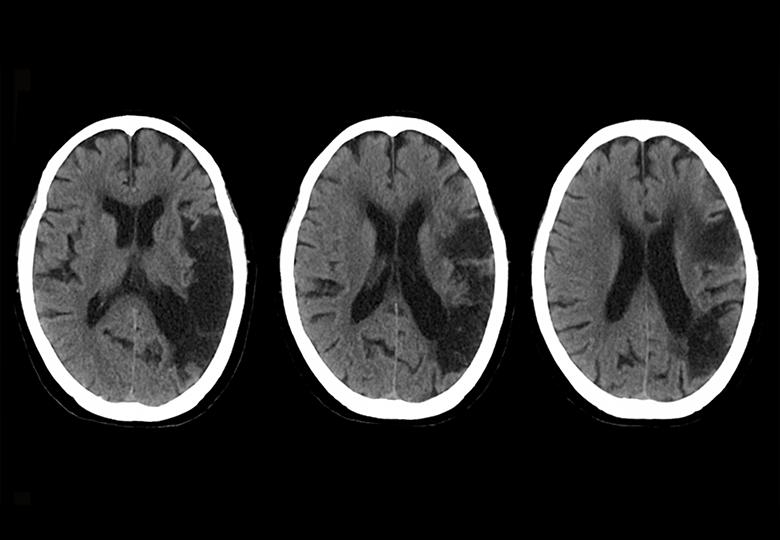 Brain (5mm)