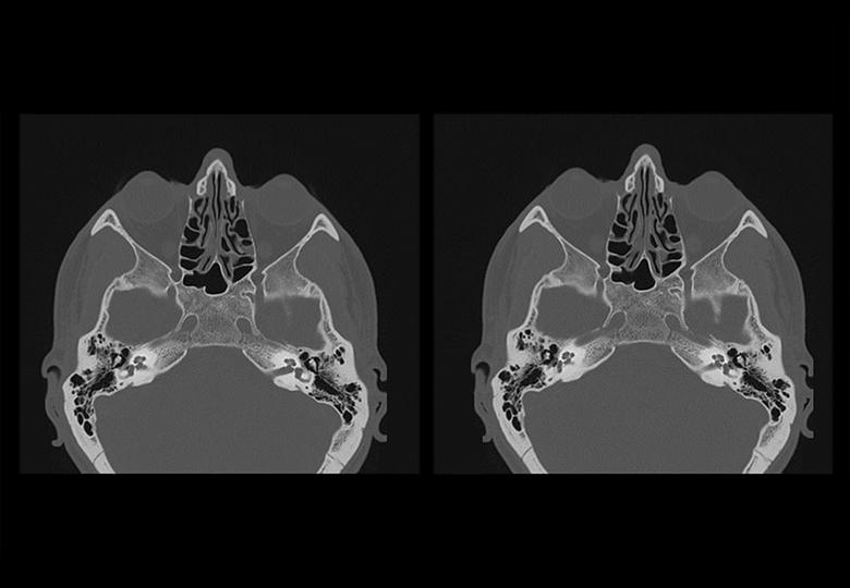 Inner ear (0.625mm)