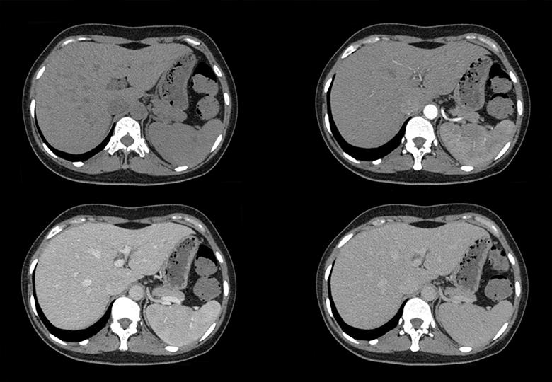 Routine scan + third phase enhancement (0.625mm)
