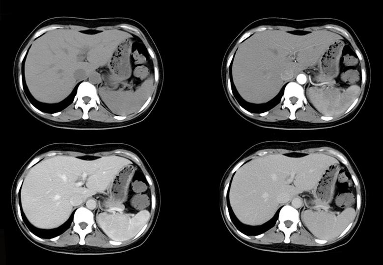 Routine scan + third phase enhancement (5mm)