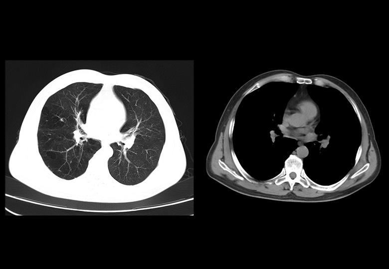 Lung (1.25mm)