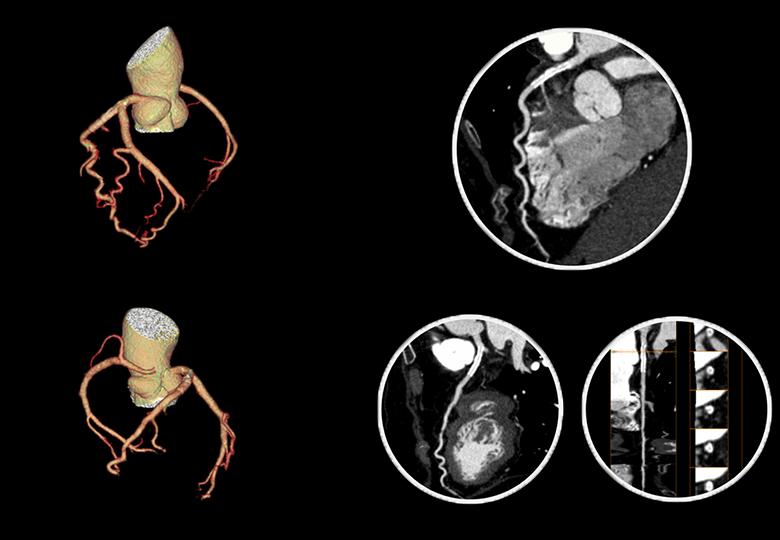 Coronary imaging