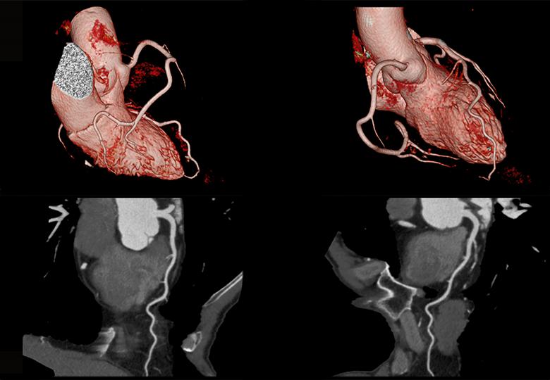 Coronary CTA