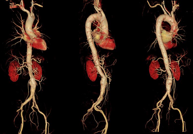 Thoracic and abdominal pelvic CTA