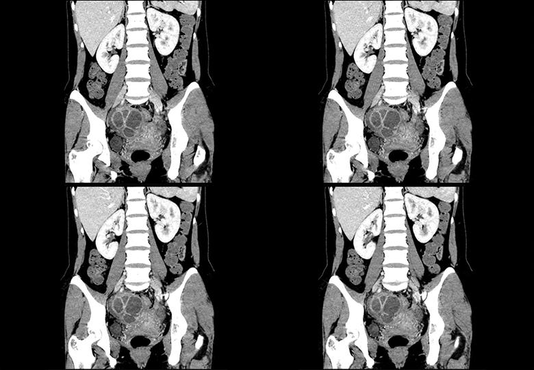 Pelvic _C+MPR reconstruction