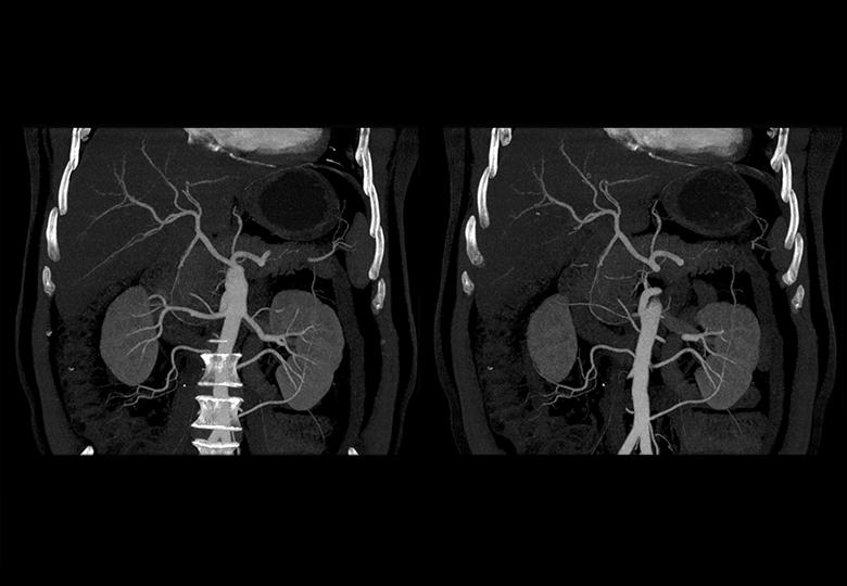 Abdominal blood vessels (MIP)