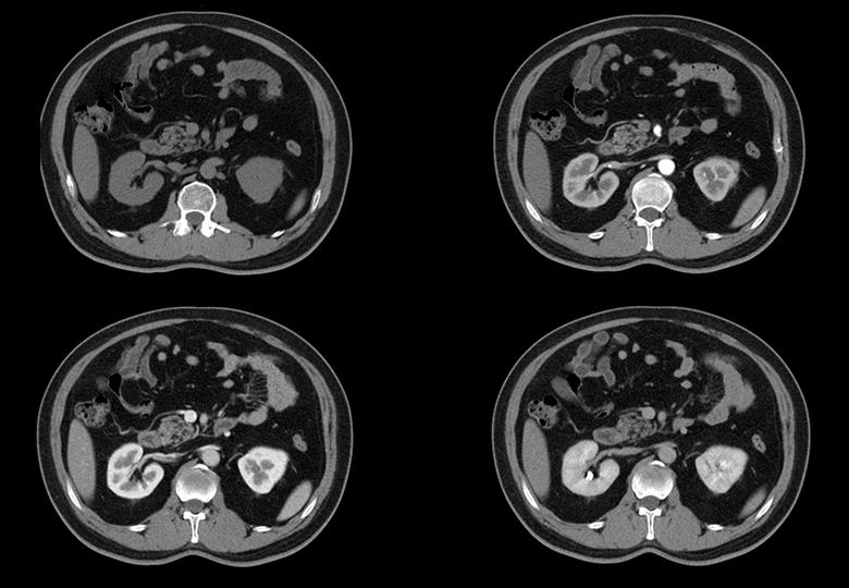 Kidney, 5mm