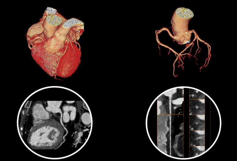 Cardiac coronary artery