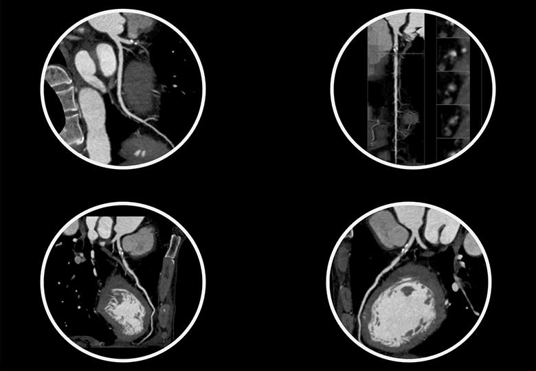 Cardiac coronary artery