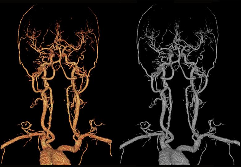 Head and neck CTA