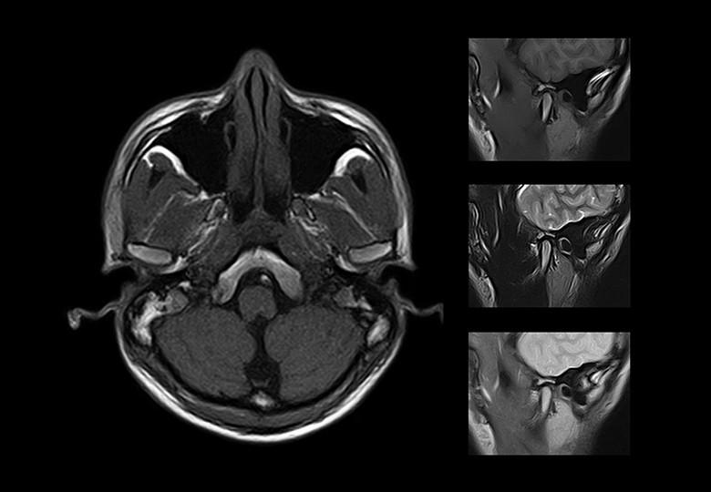 TMJ_FSE3D, High resolution images, 2mm thickness