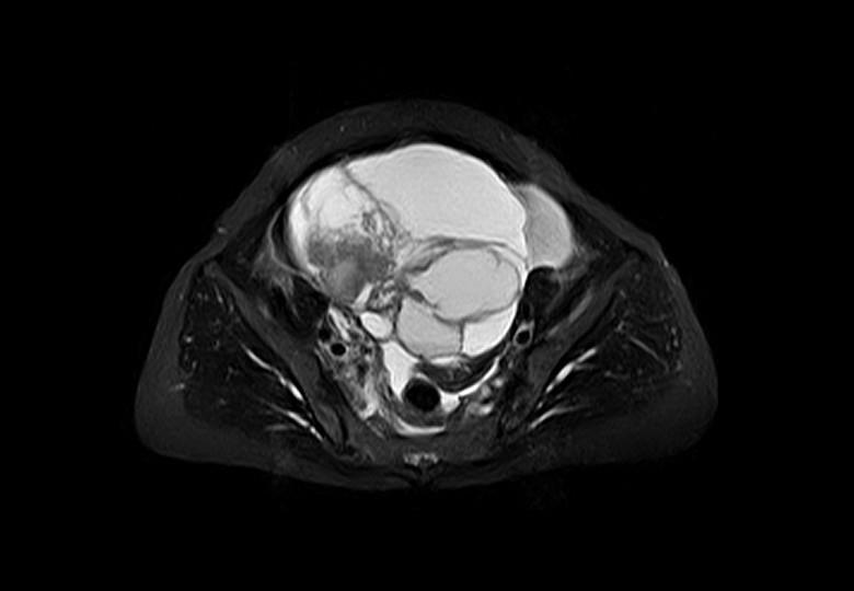 Pelvic Tumor_T2_STIR