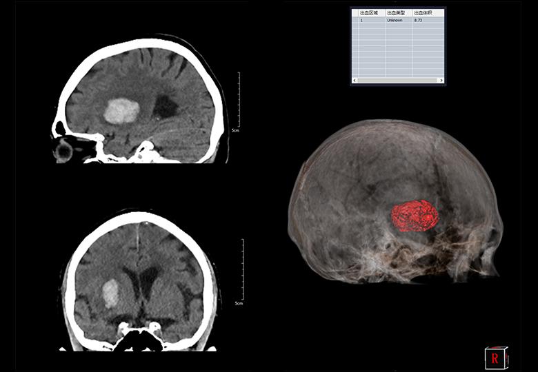  Análisis de hemorragia cerebral 