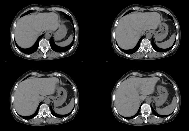 Routine_1mm_Kidney 