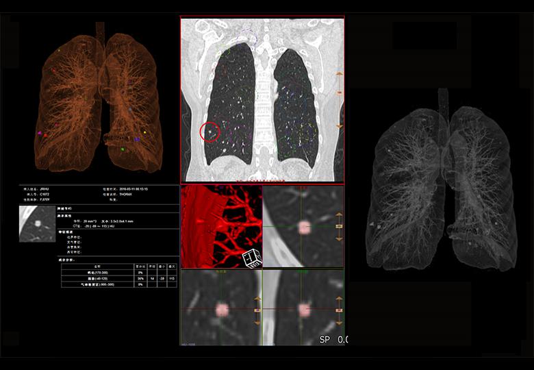  Análisis de nódulos pulmonares 