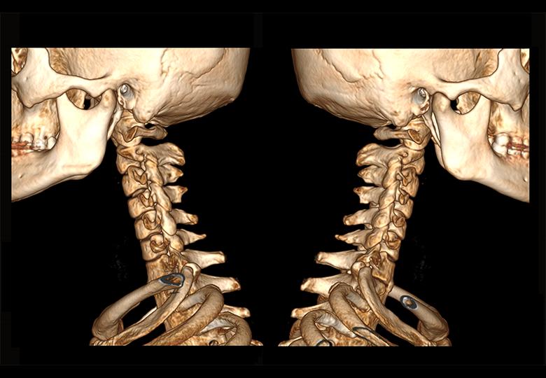 Reconstruction VR de la vertèbre cervicale