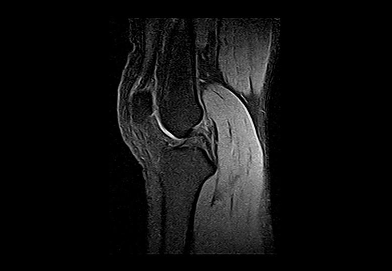 Knee_DIXON