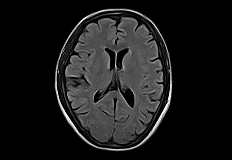 Brain_T2_Flair