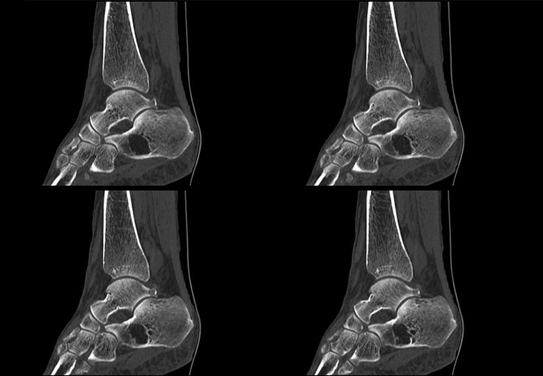 Ankle joint MPR reconstruction (0.3125mm)