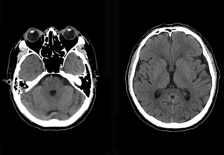 Routine scan(5mm)