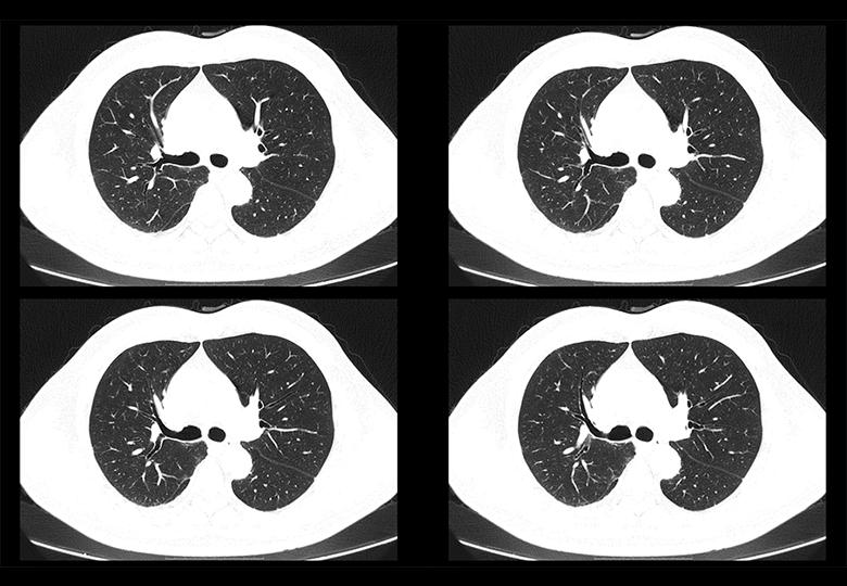 Routine scan(1.25mm)