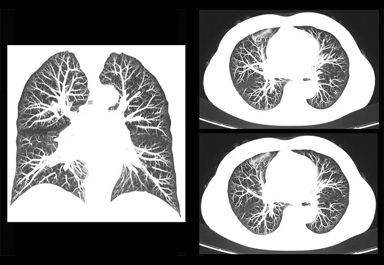 MIP reconstruction