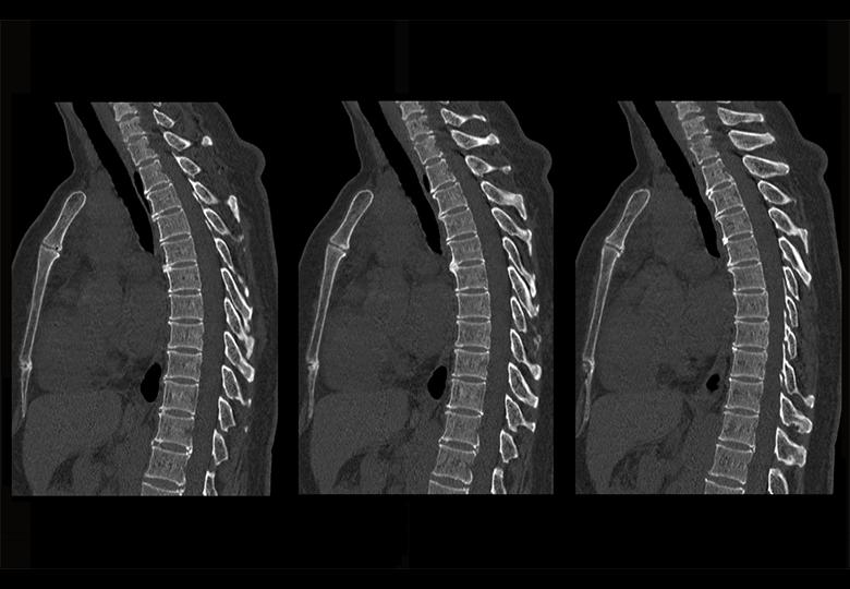 Thoracic MPR reconstruction(1.25mm)