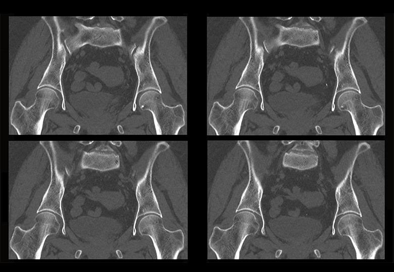 Hip joint MPR reconstruction