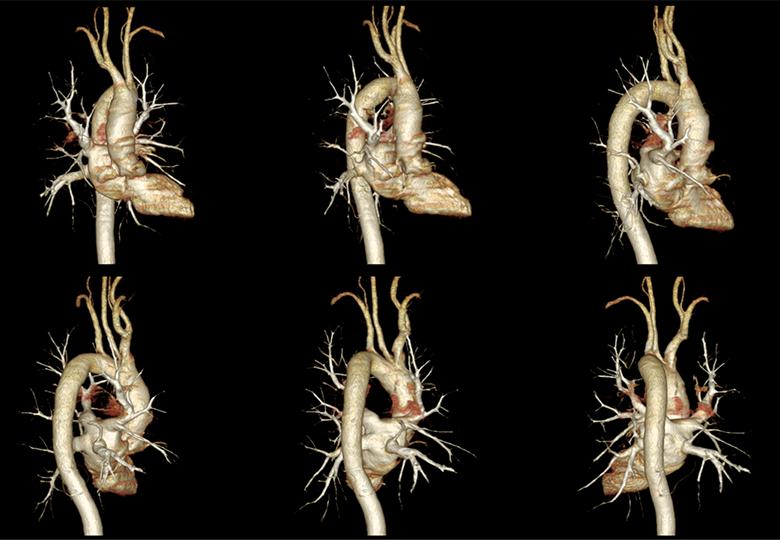 Chest CTA imaging