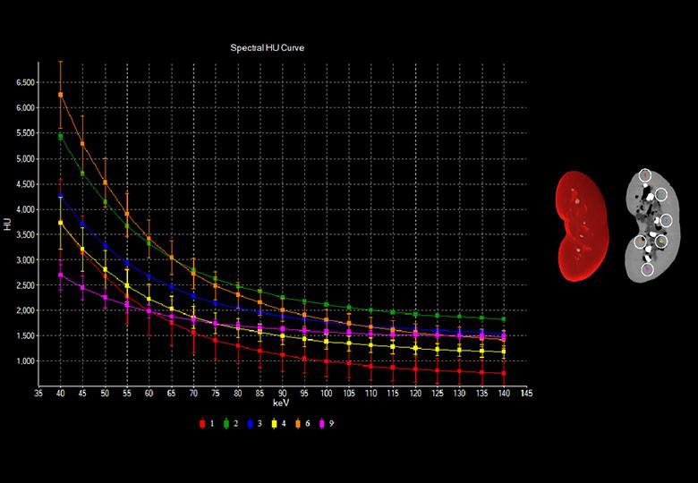 Renal Calcification Analysis