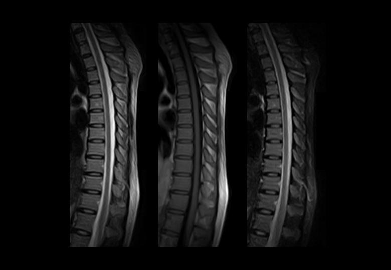 t2_fse_sag & t1_fse_sag & t2_stir_sag