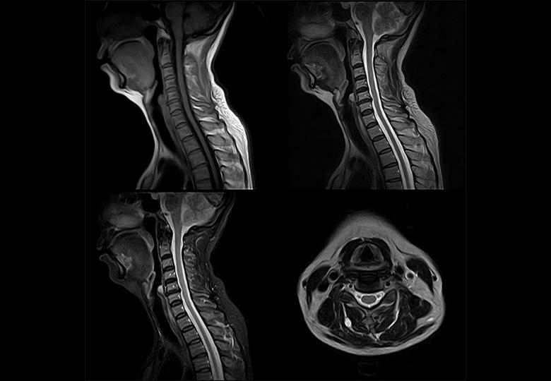 t1_fse_sag & t2_fse_sag & t2_stir_sag & t2_fse_tra