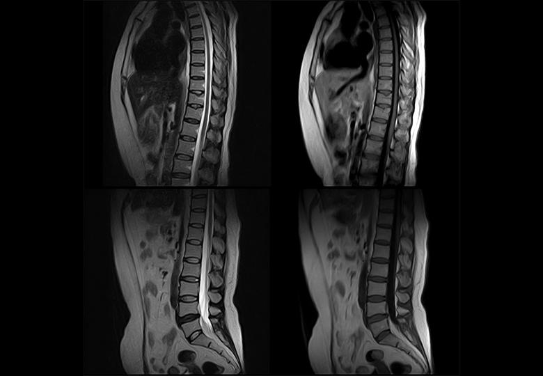 t2_fse_sag & t1_fse_sag & t2_fse_sag & t1_fse_sag