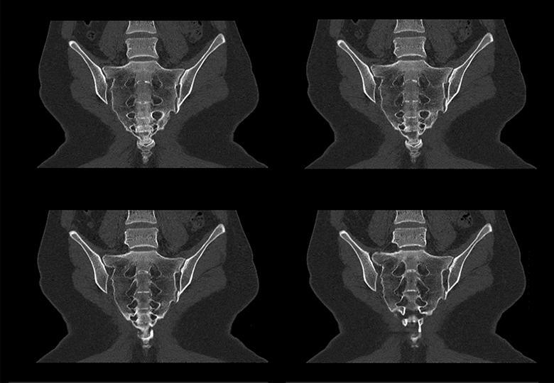  Caudal vertebra reconstruction 