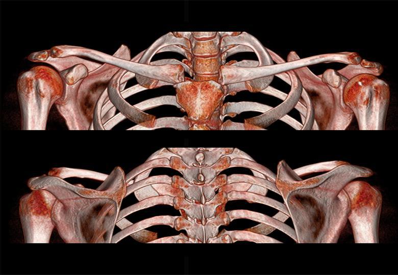  VR reconstruction of the cervical vertebra 